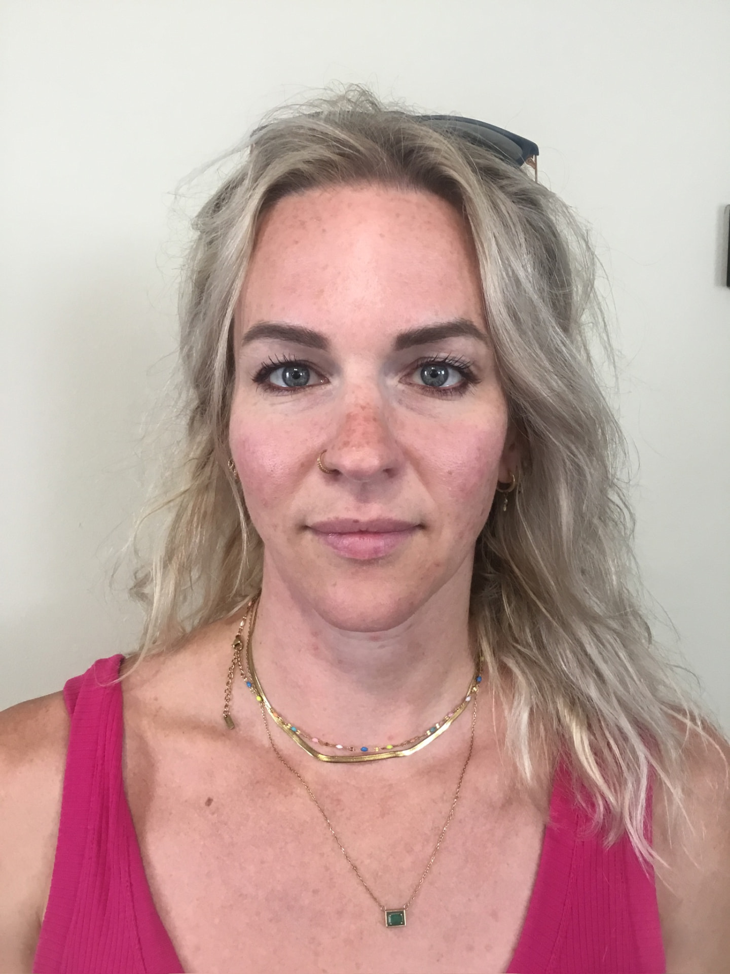 Client before dermal filler to nasolabial folds at Aevora Clinic