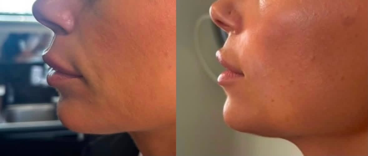 Client before and after dermal filler to nasolabial folds at Aevora Clinic