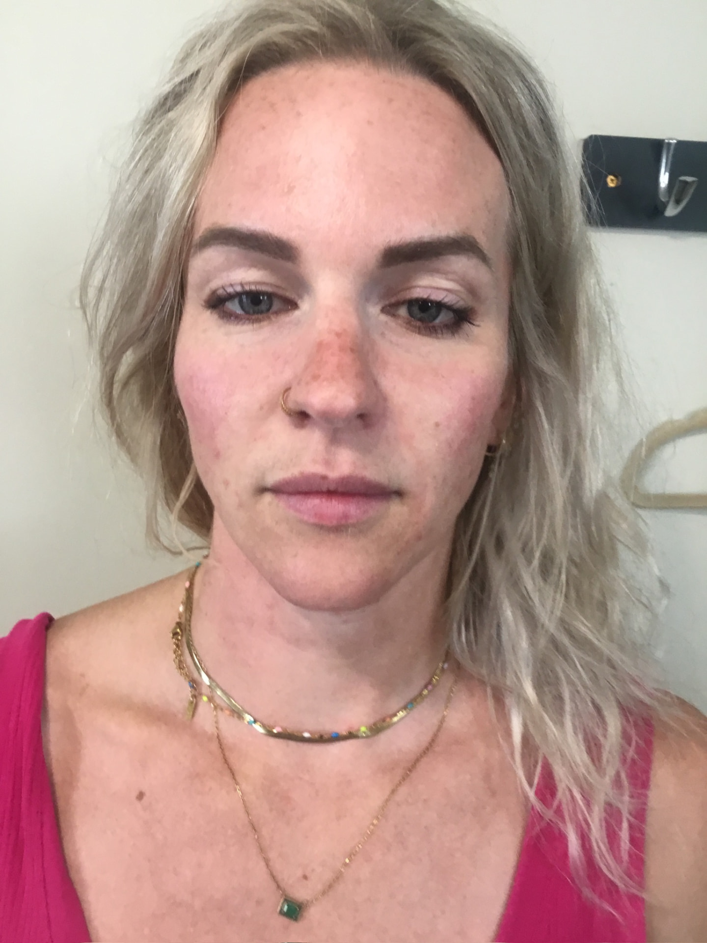 Client after dermal filler to nasolabial folds at Aevora Clinic
